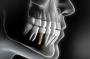 Calgary Dental Implants | Best Affordable Dental Implants Calgary