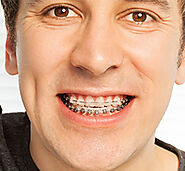 Get Invisible Braces from Galaxy Dental at Affordable rates in SE, Calgary