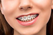 Everything You Need to Know about Orthodontic Treatments - Galaxy Dental