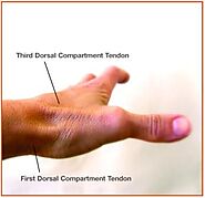 De Quervain Syndrome | dequervainscure