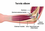 Tennis Elbow Specialist