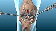 Anterior Cruciate Ligament Treatment in Vadodara