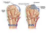 Avascular Necrosis Treatment Doctor in Vadodara