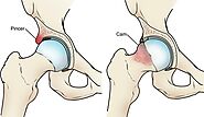 Hip Arthroscopy Surgery