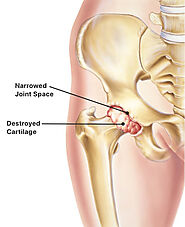 Best Hip Replacement Surgeon in Baroda