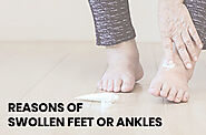 Reason of Swollen Feet or Ankles