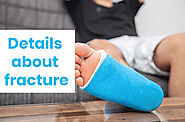 Details About Fracture - Top Orthopedic Doctor in Vadodara