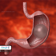 بالون معده روشی که منسوخ شده است