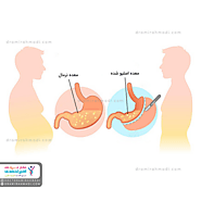 هر آنچه که باید درباره عوارض اسلیو معده بدانید - کلینیک فوق تخصصی لاغری