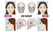 Why Do You Need Square Jaw Reduction Surgery?