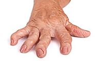 Ayurvedic treatment for Arthritis | Osteoarthritis, Rheumatoid Arthritis, Gaut