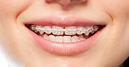 Importance of orthodontic treatment