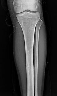 What is Stress Fracture of the Tibia and how it can be treated?