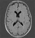 Migraine-associated brain changes not related to impaired cognition, November 13, 2012 News Release - National Instit...