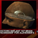 A Pacemaker for the Brain? Doctors Hopeful About Possible Alzheimer’s Treatment | Fox News Insider