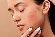 Natural Home Remedies and Treatments to Get Rid of Acne Scars