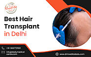 Everything One Needs To Know About FUE Hair Transplant