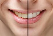 Teeth Whitening in Edmonton | Teeth Whitening Near You