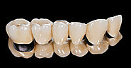 Dental Crowns in Edmonton | Dental Bridges in Edmonton