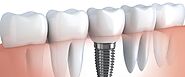 Dental Implants in Edmonton | Dental Implants Near You | implants in Edmonton