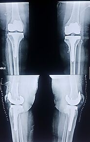 Knee Replacement Surgery in Delhi - Knee Surgery in Delhi