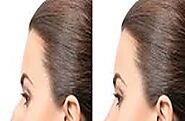 Rhinoplasty - A Popular Procedure in Dubai