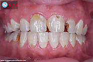 Relationship between Cancer & Dental Problems - Emergency Dental Service - JustPaste.it