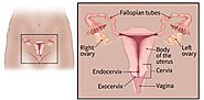 Types of Cervical Cancer