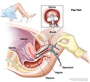 Cervical Cancer Diagnosis