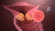 Risk Factors For Cervical Cancer