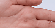 Brief Introduction to Warts