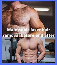 Best #1 Male Pubic Laser Hair Removal Before and After Image
