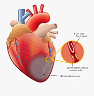 What are the Major Causes of Congestive Heart attack