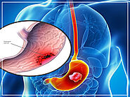 Stomach cancer Treatment, Doctor, Consultant In Noida, Delhi | Dr. Manish Singhal
