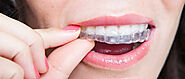 10 Questions to Ask Your Dentist About Invisalign