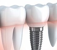 Replace Your Missing Teeth With Dental Implants