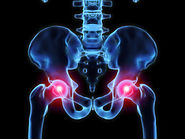 How therapy will help Hip Pain