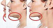 Can you get rid of double chin without surgery?