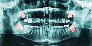 Wisdom Tooth Extraction & Surgery in Singapore