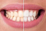 Teeth Whitening in Shawnessy
