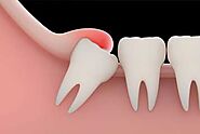 Wisdom Tooth Extraction in Shawnessy
