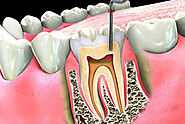Root Canal Therapy in Shawnessy