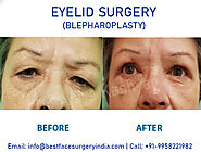 KAS MEDICAL CENTER : Eyelid or Blepharoplastyin Surgery in Delhi