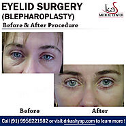 Best Eyelid Surgery or Blepharoplasty in Delhi at Affordable Cost