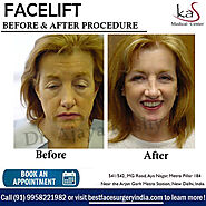 Best Facelift Surgery Cost in DrKashyap Clinic in Delhi