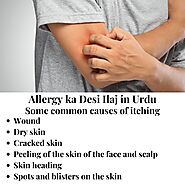 The best treatment for itching (allergy ka desi ilaj in urdu). Treatment of skin allergies.