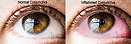 What is Pink Eye (Conjunctivitis), causes & how to treat them?
