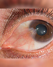 How do you stop a pterygium from growing?