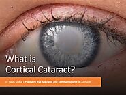What is Cortical Cataracts?