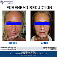 Are You Looking for Best Forehead Reduction Surgeon in Delhi